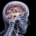 alzheimer en el cerebro